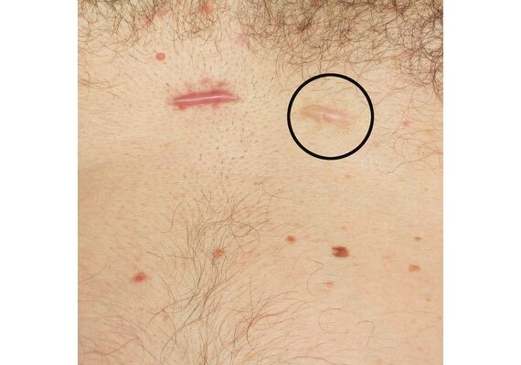 Strataderm Γελη Σιλικόνης Κατά Των Ουλων 20gr - Δερματικές Καταστάσεις στο Dvcare