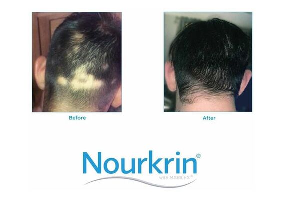 Nourkrin Man Nourishes The Hair And Supports The Normal Hair Grwth Cycle For Hair Preservation 60 tabs - Τριχόπτωση στο Dvcare